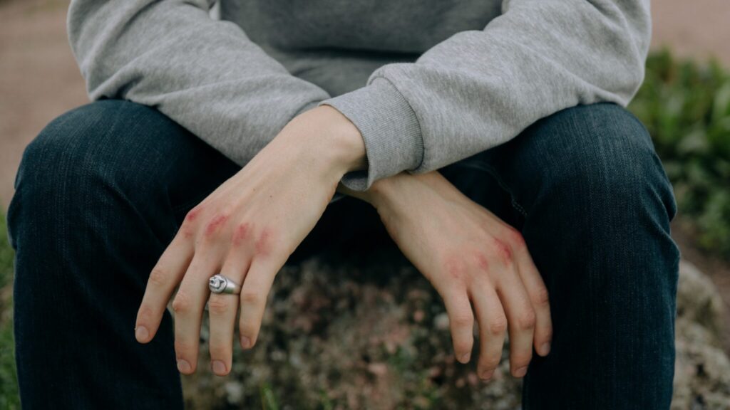 Young man with bruised knuckles